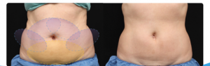 coolsculpting T2T