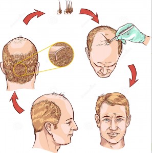 hair-transplantation-vector-image-illustration-55253149